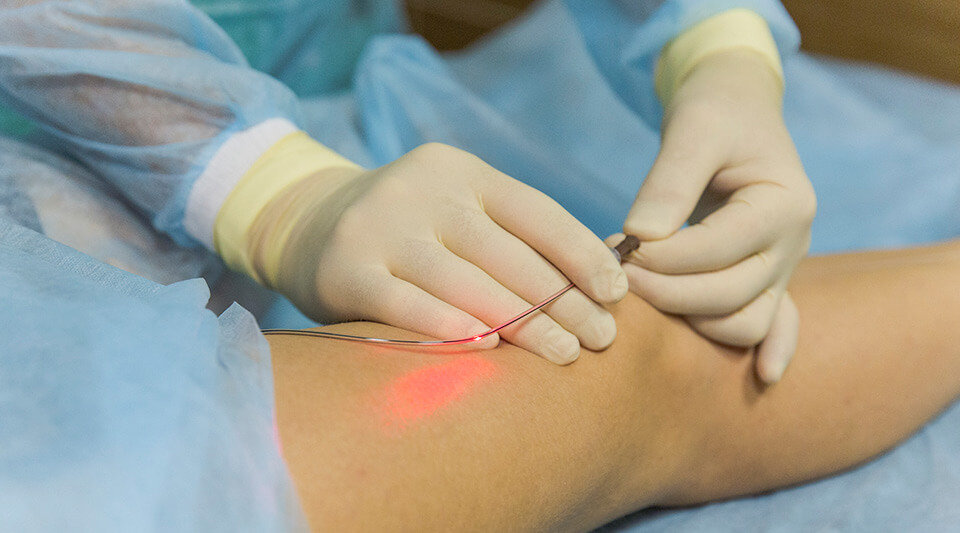 Phẫu thuật suy giãn tĩnh mạch có để lại biến chứng không?